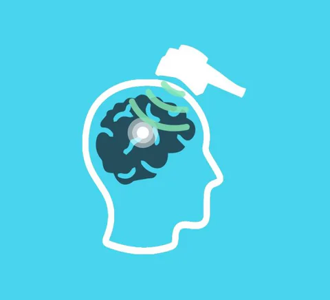 Ilustración de una cabeza y un dispositivo de estimulación magnética.